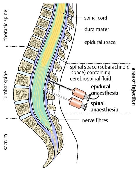 Difference between epidural and spinal injection's | Epidural, Anesthesia, Spinal