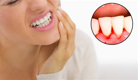 GUM DISEASE SYMPTOMS – United Dentist