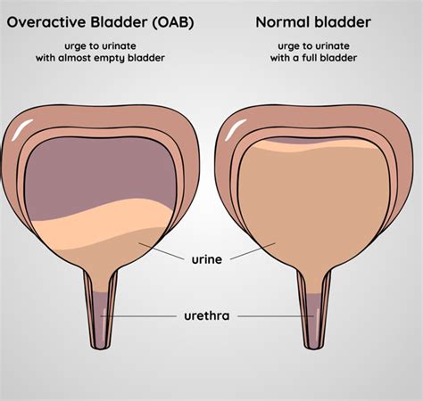 Overactive Bladder - Limitless