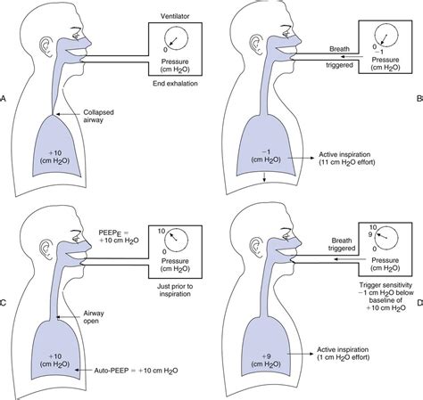 Final Considerations in Ventilator Setup | Thoracic Key