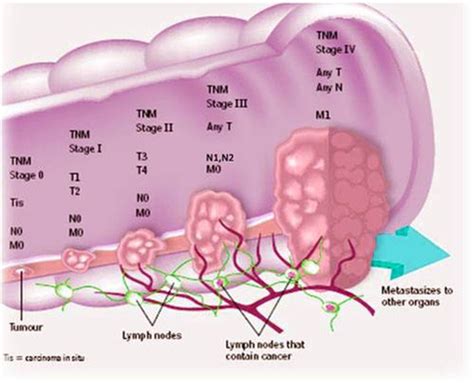 Colon cancer | Anatomy System - Human Body Anatomy diagram and chart images