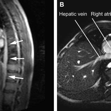 CT of the normal azygos venous system. Contrast-enhanced CT axial ...