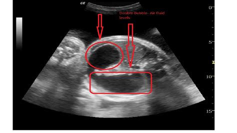 Duodenal atresia echocardiography and ultrasound - wikidoc