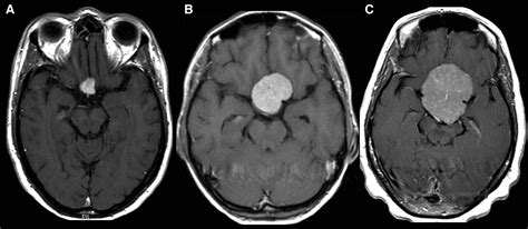 Tuberculum Sellae Meningiomas | Neurosurgery Blog