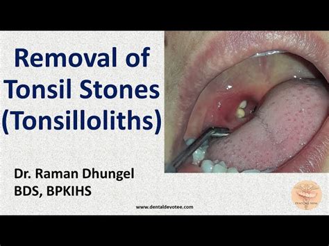 Tonsilloliths Removal