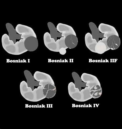 Bosniak Classification For Renal Cysts Radiology Imaging, Medical ...