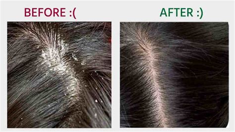 How To Remove Dandruff, Dandruff Treatment, Personal Experience & Best Solution