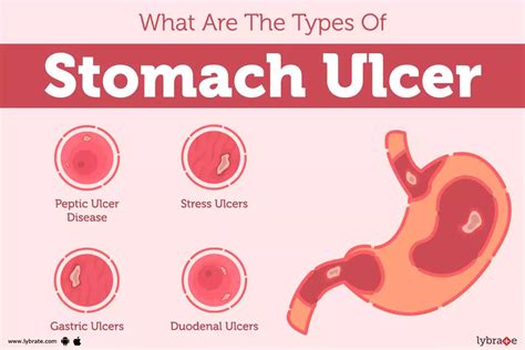 Gastric Ulcer Types