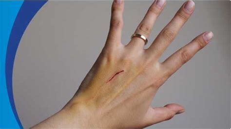 Tetanus Symptoms | Healthcare-Online