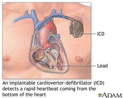 Cardiac Defibrillator