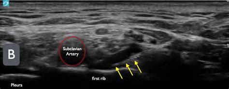 How To: The Ultrasound-Guided Supraclavicular Brachial Plexus Block - Page 4 of 5 - ACEP Now ...