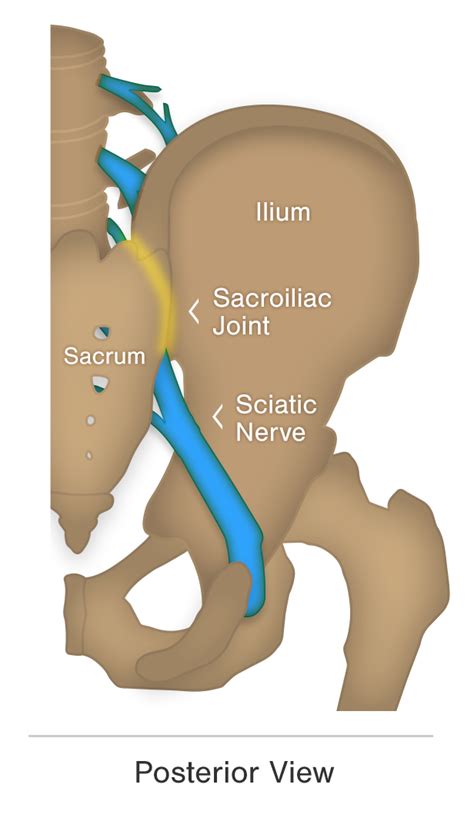 Is Your Sciatica Coming From Your Spine or Your SI Joint? | SI-BONE