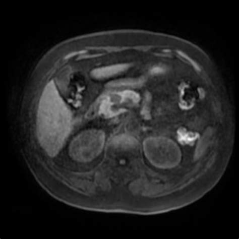 Insulinoma | Image | Radiopaedia.org