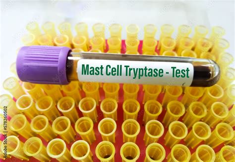 Blood sample tube for Mast cell Tryptase test. A Tryptase test can help ...