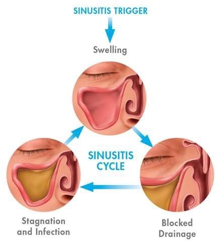 Sinusitis Treatment Houston | Nasal Congestion | Headache Houston Tx