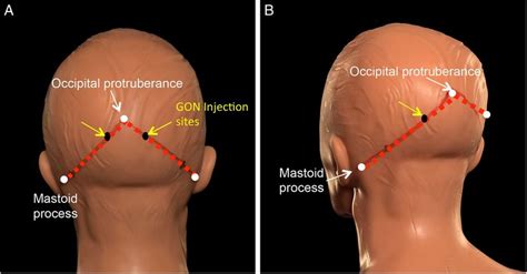 Injection sites for greater occipital nerve (GON) block. The injection... | Download Scientific ...