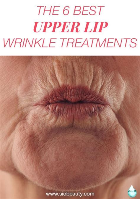 The 6 Best Upper Lip Wrinkle Treatments | Lip wrinkle treatment, Lip ...