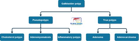 Gallbladder Polyp: Symptoms, Cause, Size, Treatment & Surgery