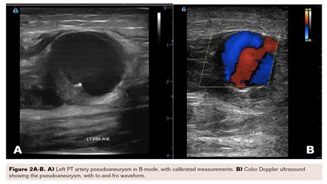 Iatrogenic Pseudoaneurysm of the Posterior Tibial Artery | VDM