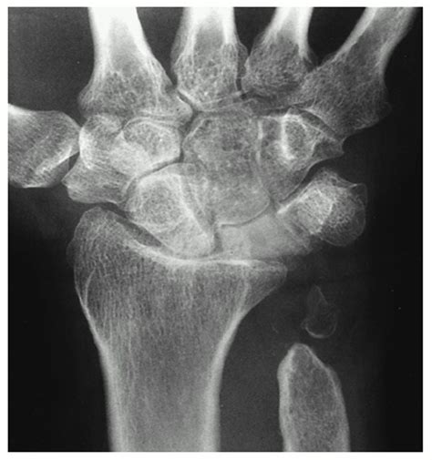 The Results of Treatment of Synovitis of the Wrist Induced b... : JBJS