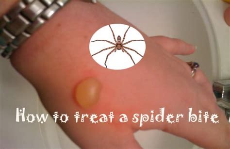 15 Home Remedies to Treat a Spider Bite Quickly at Home