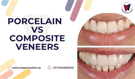 Porcelain Veneers vs Composite Veneers | Which One Best For You?