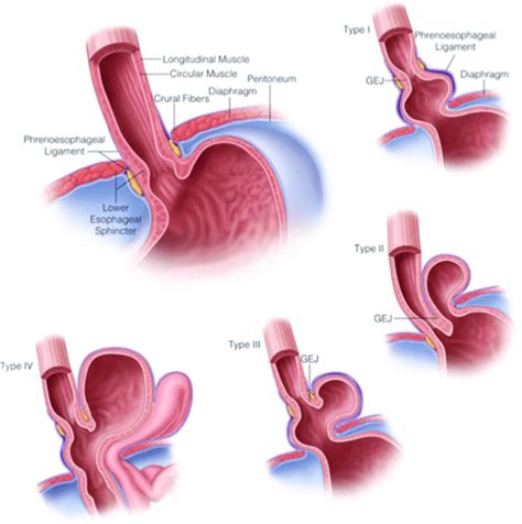 Normal anatomy of the esophageal hiatus shown with examples of... | Download Scientific Diagram