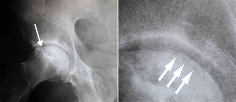 Osteonecrosis of the Hip - OrthoInfo - AAOS