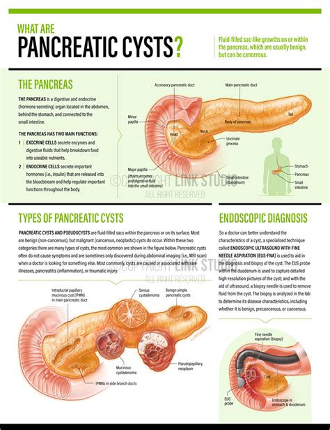 Pancreatic Cysts - Link Studio - Medical Illustration