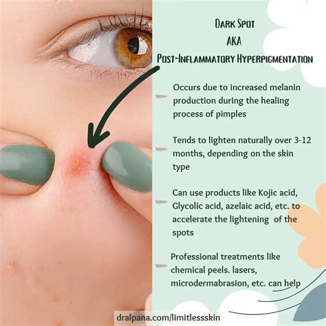 How to Remove Dark Spots Caused by Pimples: Dermatologist Explains