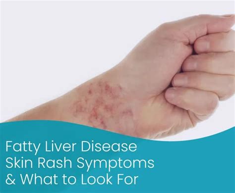 Fatty Liver Liver Disease Skin Rash Pictures: Full Information 2023 » Stoodmens.com