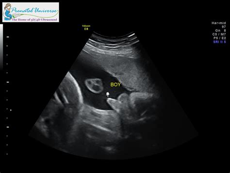 9 Weeks Pregnant 3d Ultrasound