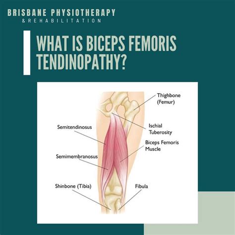 What is Biceps Femoris Tendinopathy? - Brisbane Physiotherapy