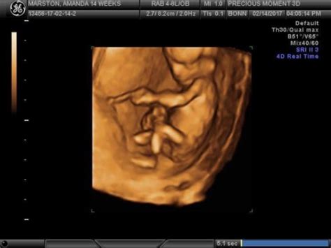 How To Tell Gender On Ultrasound 13 Weeks