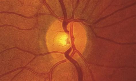 Normal optic disc - American Academy of Ophthalmology