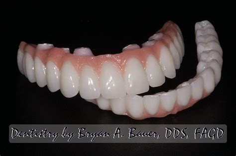 Implant Supported Vs Implant Retained Dentures - tacitceiyrs