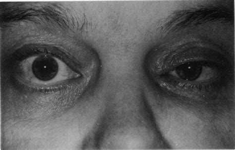 Case 1, showing left sided ptosis and enophthalmos. | Download ...