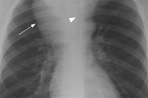 Left & Right Paratracheal Mass Symptoms, Causes, Treatment