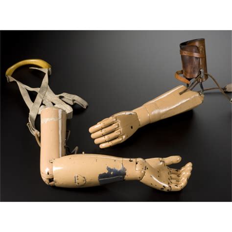 Upper Limb Prosthesis at Rs 25000 | Artificial Limbs in Secunderabad | ID: 11279848233