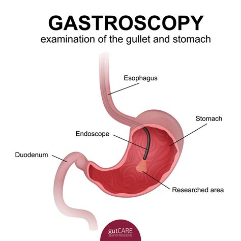 Gastroscopy (Upper GI Endoscopy)| Singapore| Cost | gutCARE