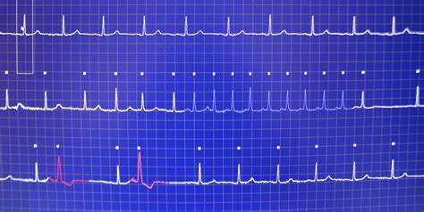 Heart rate monitor - Cardiology Specialists