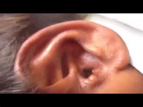 Ear botfly Botfly extraction human YouTube - YouTube