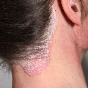 13 Photos of Plaque Psoriasis