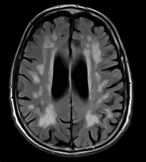 Vascular Dementia Vs Normal Brain