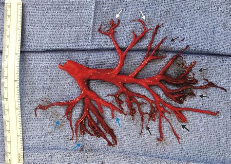 Man coughs up startling blood clot shaped like a lung passage - CNET