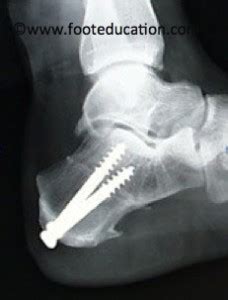 Calcaneal Osteotomy - FootEducation