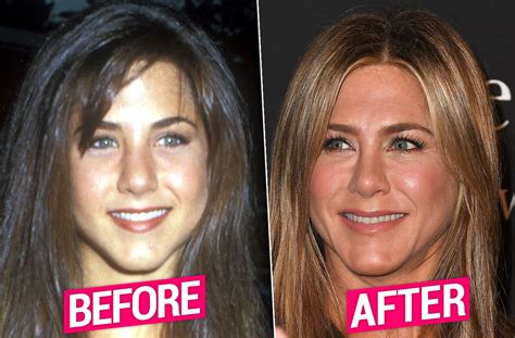 Jennifer Aniston Nose Job Before After