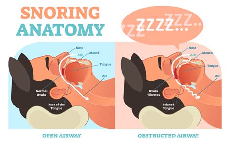 5 surprising reasons why you could be snoring