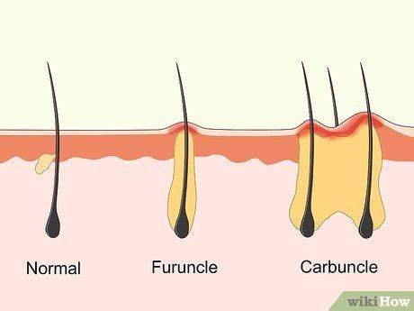 Carbuncle Vs Furuncle