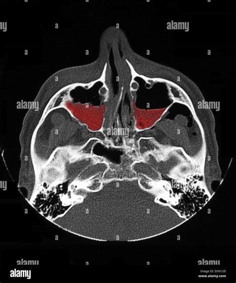 CT scan image showing bilateral maxillary sinus fractures Stock Photo - Alamy